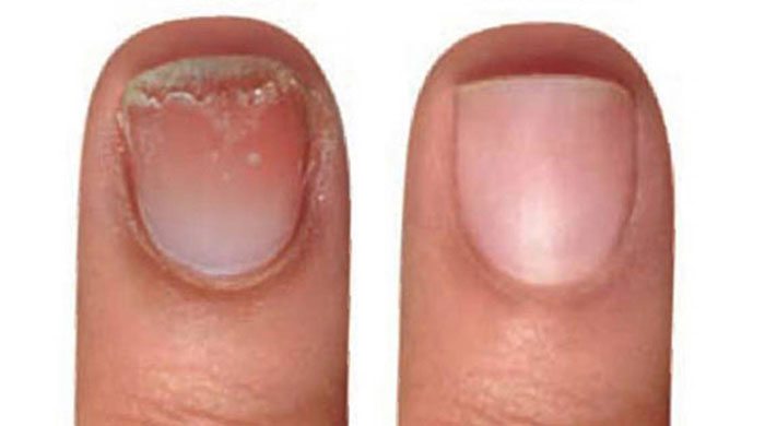 Nails Before And After