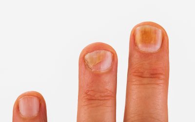 7 Tricks to Keep Your Nails Healthy