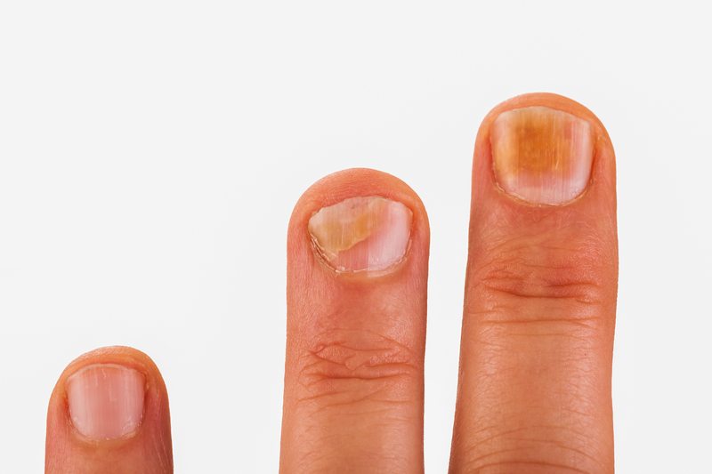 7 Tricks to Keep Your Nails Healthy