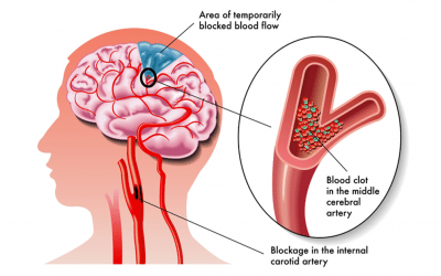 7 Easy Ways to Reduce Your Blood Pressure